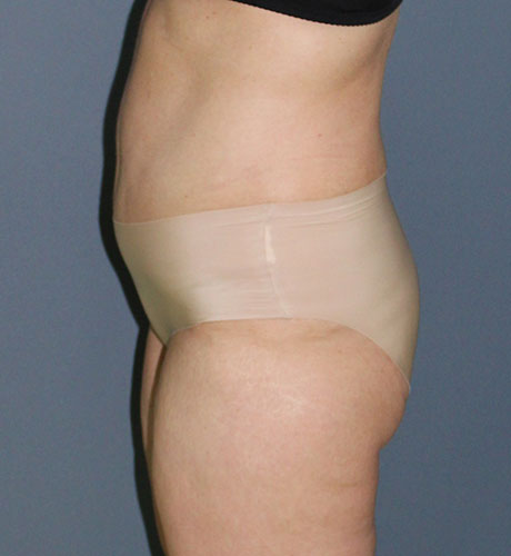 lipoabdominoplastie