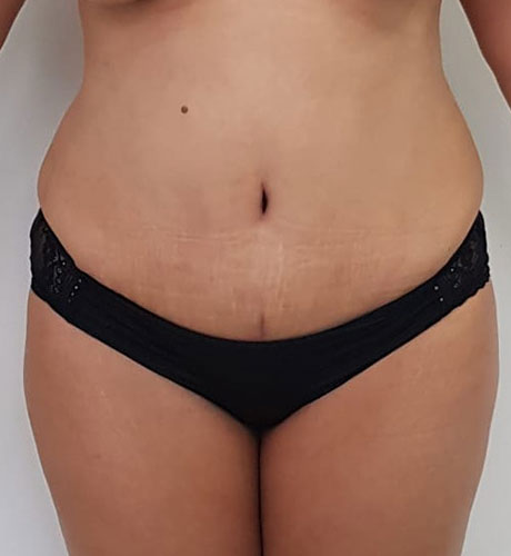 lipoabdominoplastie