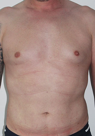 liposculptura