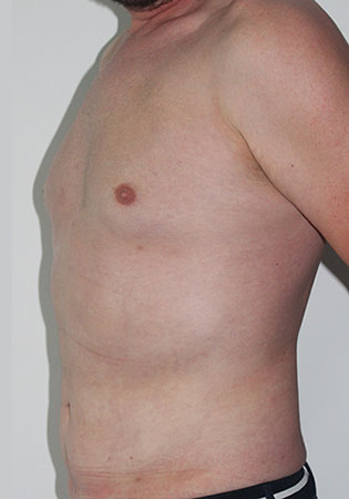 liposculptura