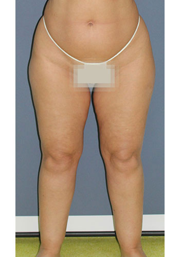 liposculptura - preoperator