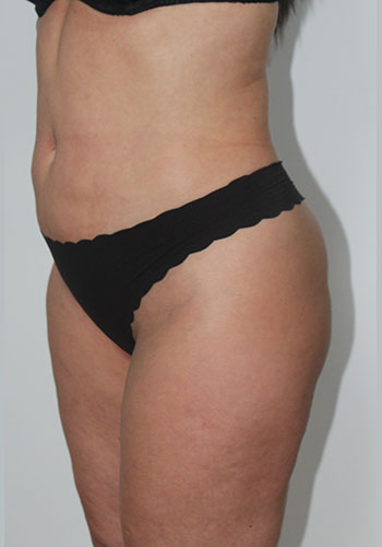liposculptura - postoperator 2 luni