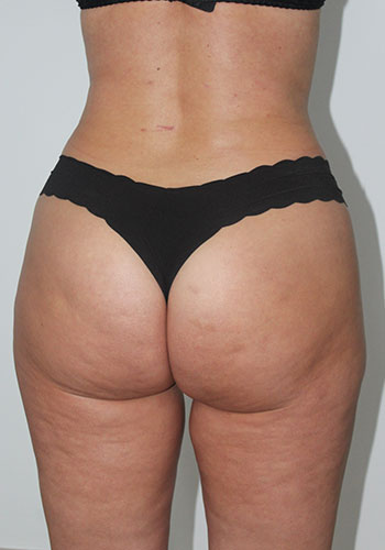 liposculptura - postoperator 2 luni
