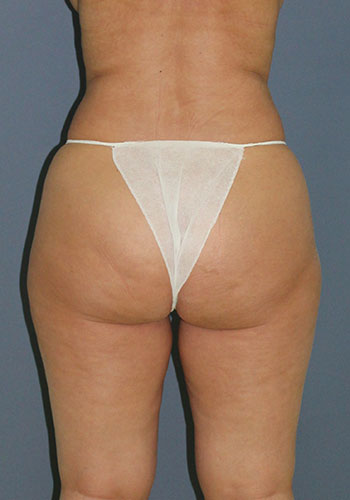 liposculptura - preoperator