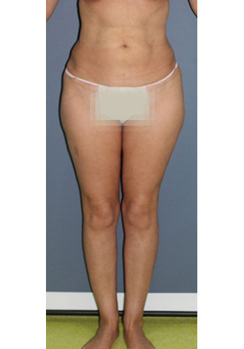 liposculptura - preoperator